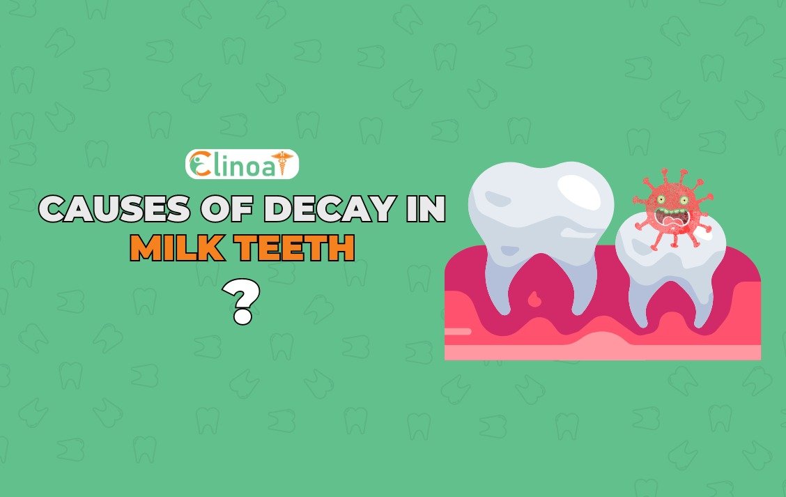 Causes of Decay in Milk teeth - Clinoa - Best dentist in pondicherry