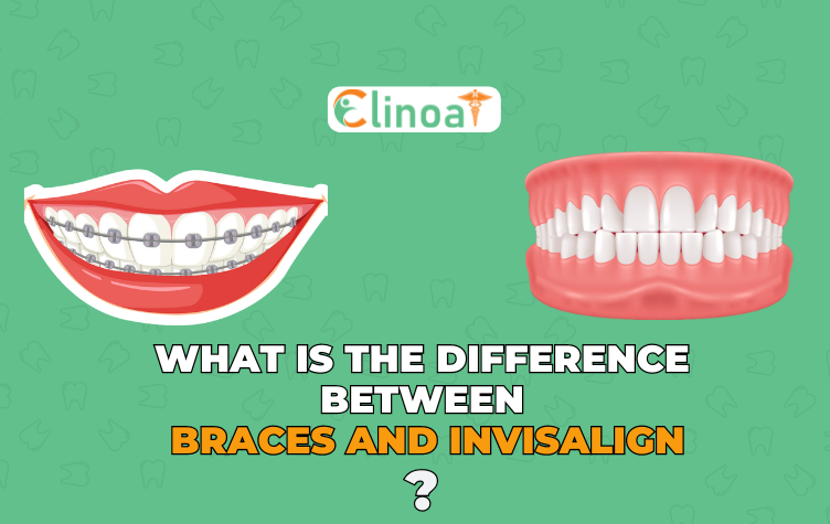 Difference Between Braces And Invisalign - Clinoa - Best Dentist in Pondicherry