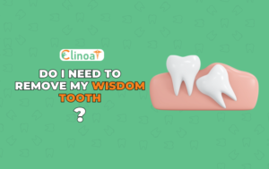 Do I need to remove wisdom teeth - Clinoa - Best Dental clinic in pondicherry